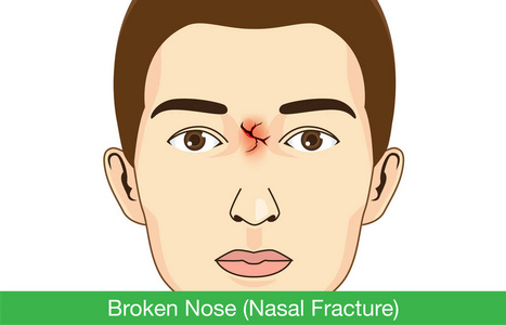 破了的鼻子上脸的男人照片