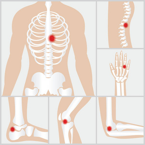 病的关节和骨骼图片