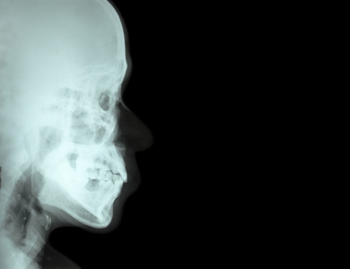 薄膜 x 射线侧鼻骨 颅侧面观，在右侧的空白区域