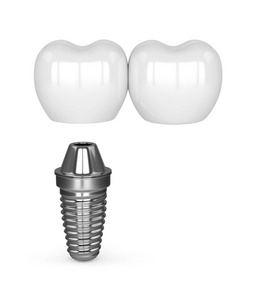 3d. 牙悬臂桥种植体植入术