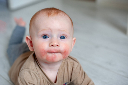 在婴儿脸颊上的素质, 过敏的痕迹