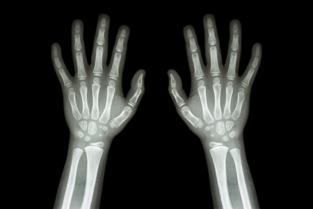 数字方阵薄膜 x 射线正常手的孩子照片