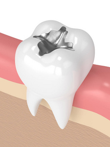 3d. 牙齿与牙科汞合金充填