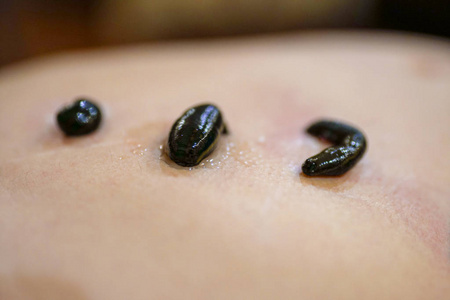 在他的胃在肝区和肚脐水蛭照片