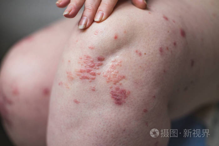 在治疗牛皮癣 湿疹和其他干燥皮肤的情况下 应用润肤剂干燥片状皮肤 健康理念照片 正版商用图片0g5b4g 摄图新视界