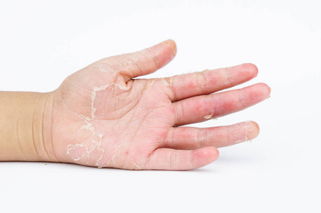 干手 剥离 接触性皮炎 真菌感染