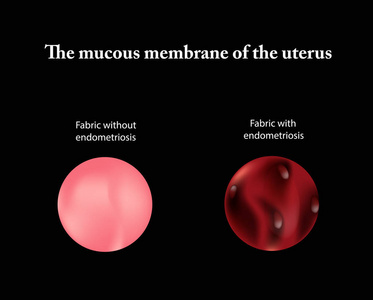 子宫内膜异位症。盆腔器官的结构。子宫腺肌病。子宫内膜。矢量图