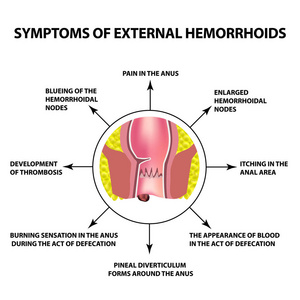 外痔疮症状。直肠中的痔淋巴结, 。图表.独立背景上的矢量插图