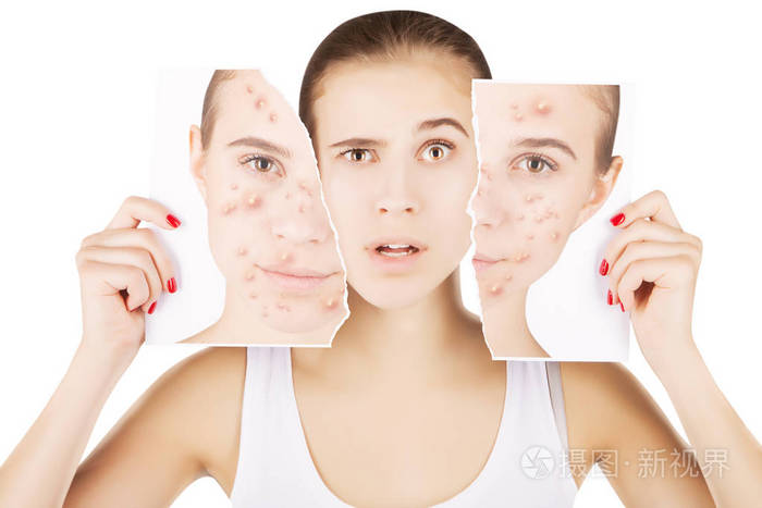 痤疮不多 !与健康皮肤的女孩