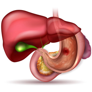 胃溃疡，内部器官解剖彩色绘图