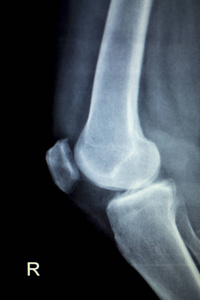 骨科膝关节损伤 x 射线扫描