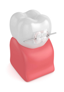 3d. 带陶瓷透明支架的牙齿渲染