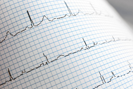 以纸张形式的心电图