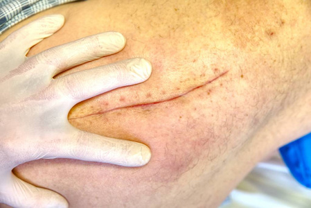 病人手术后一个月, 臀部长疤.控制愈合, 清除皮肤照片