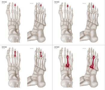 不同疼痛和关节部位的中趾足骨 X 线收集顶部和侧面保健人体解剖和医学概念在白色背景下隔离