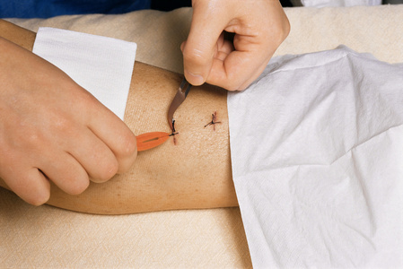 医生的手检查拆线后的模具切除手术