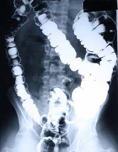 X射线结肠