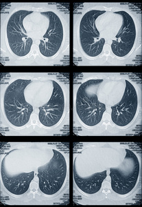 肺和心脏断层扫描