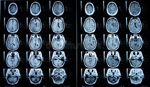 脑磁共振造影前后