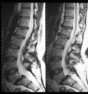腰椎矢状面mri表现照片