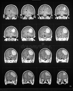 脑肿瘤mri序列分析