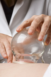 真空拔罐特写照片