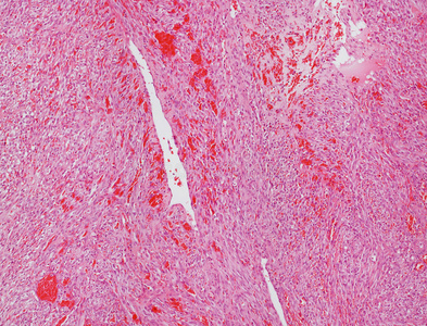 血管肉瘤显微照片