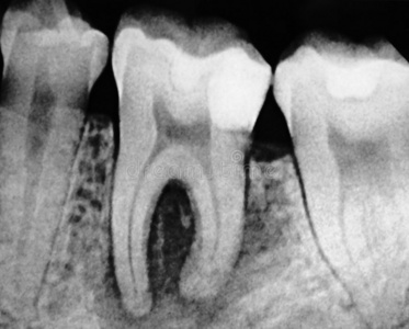 牙科磨牙x射线