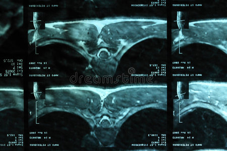 脊椎的磁共振成像