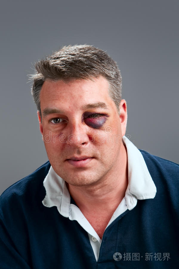 眼睛青肿的男性肖像