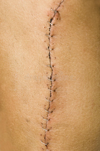 剖腹产疤痕图片