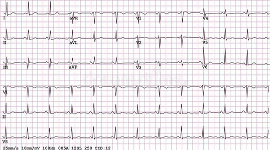 导12导联心电图照片