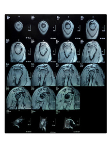 核磁共振扫描肩侧视图