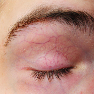 怎么画带血的带血管的眼睑照片