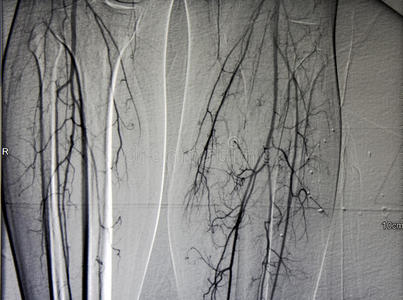 小腿血管造影照片