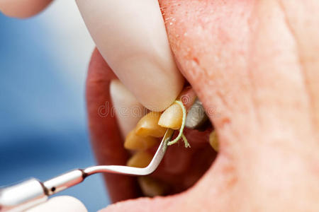 牙龈沟内放置牙线图片