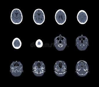 头颅计算机断层扫描
