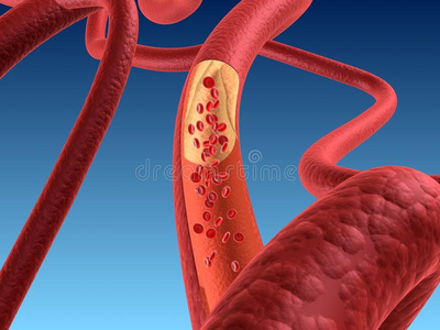 动脉硬化症