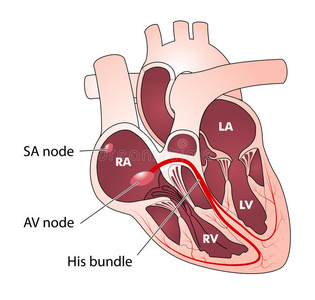 i度房室传导阻滞心脏传导照片