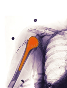 x光片显示肩关节置换