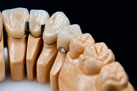 种植牙修复模型图片