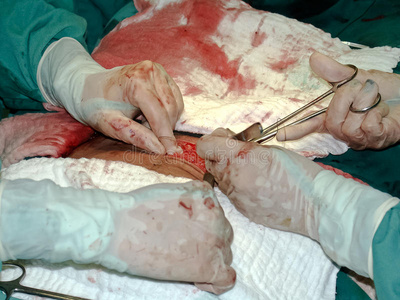 剖腹产刀口剖腹产手术照片