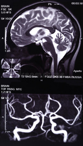 mri与mr血管造影