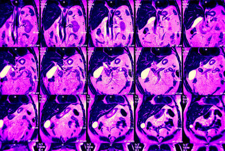 腹部核磁共振，一些冠状面图像