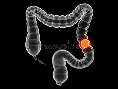 结肠癌图解