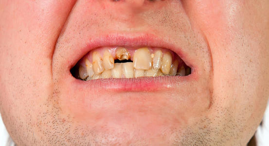 白色牙齿卫生圣 cado 房子和船在沙子里,法国微笑与完美的牙齿在家里