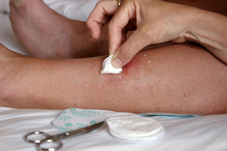 清洗伤口正在清洗的腿伤照片