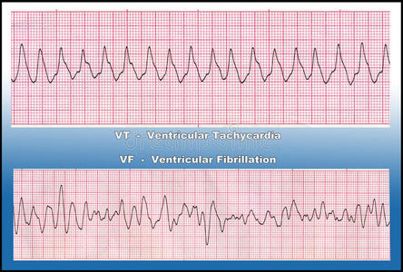 药物-致命性心律失常-室颤和室颤照片