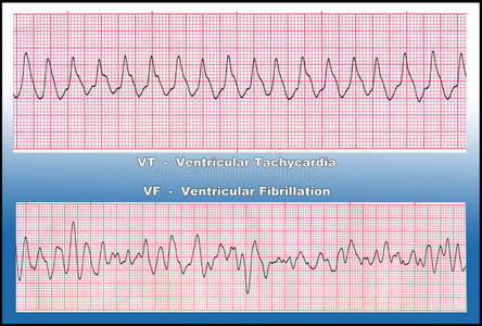 室颤波形特点图片图片