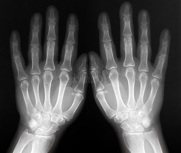 框架矢量插图人体骨骼射线照相术手和手腕放射照相术双手的放射照相术